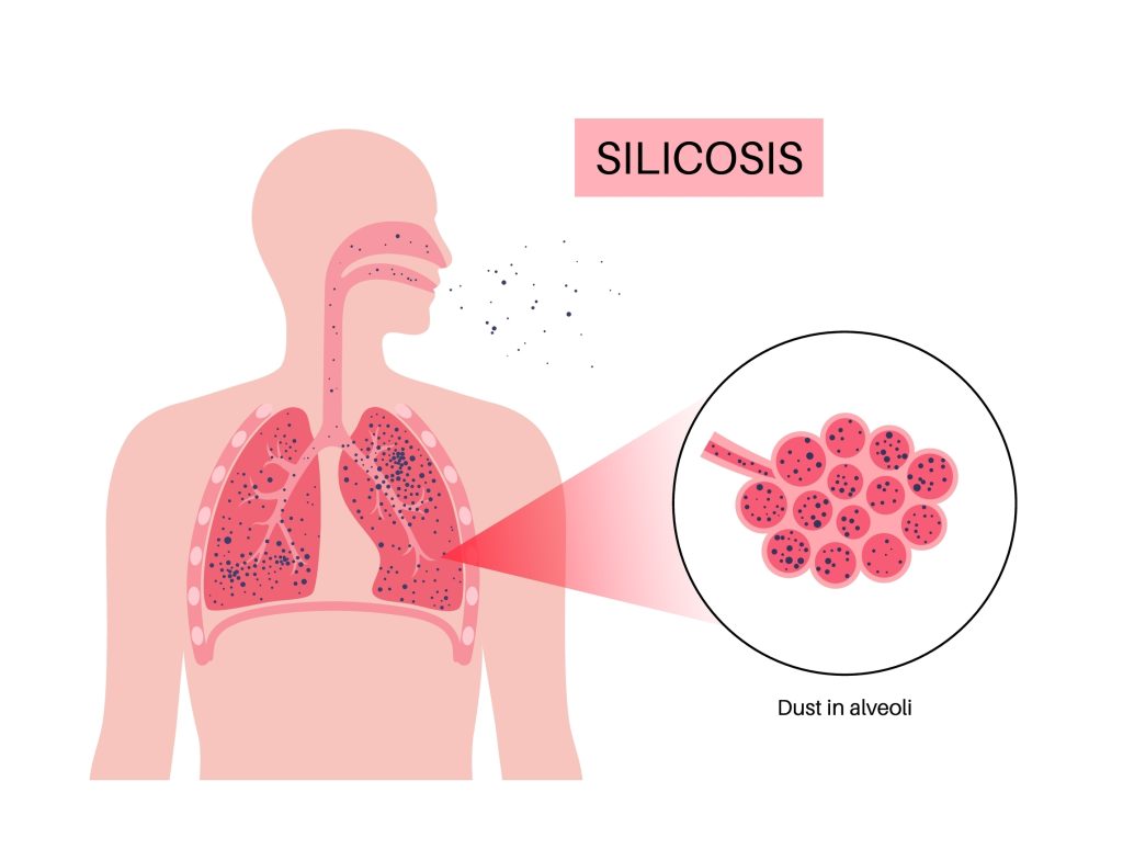 silicosis